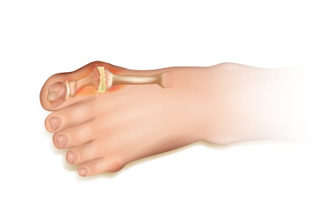 an animation of toe with gout