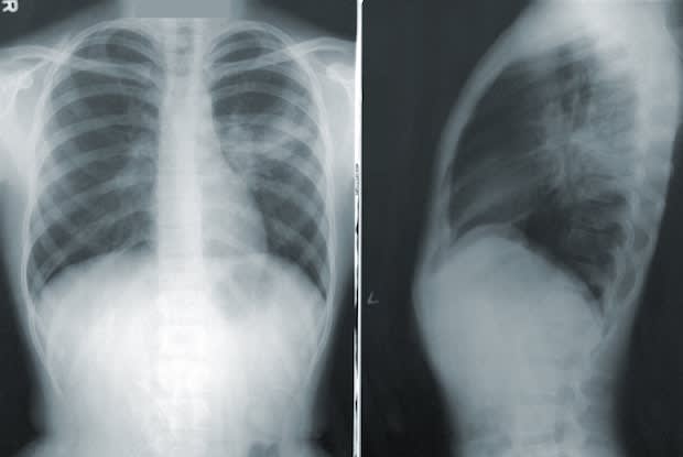 an x-ray of a person’s lungs