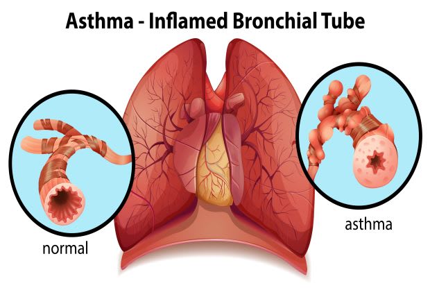 a diagram showing normal and inflamed bronchial tubes