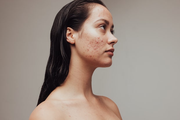 a woman with acne