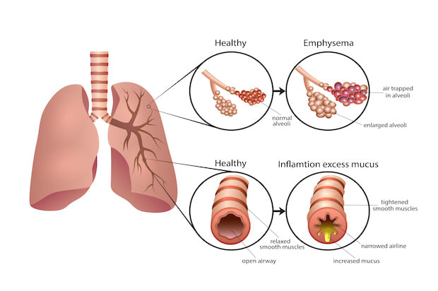 a diagram displaying the effect of COPD on the lungs