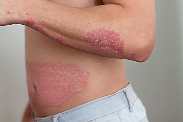 psoriasis patches on a person