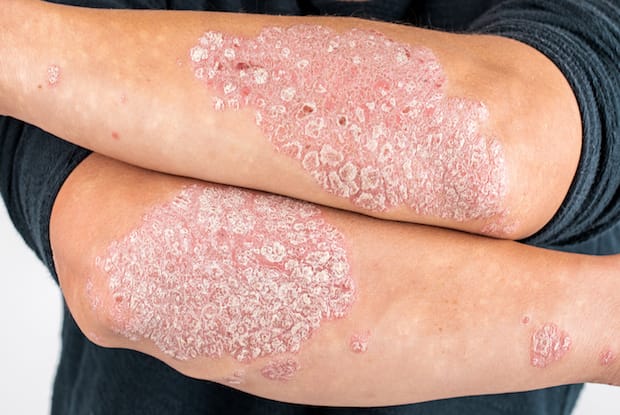 psoriasis patches on a person’s arms