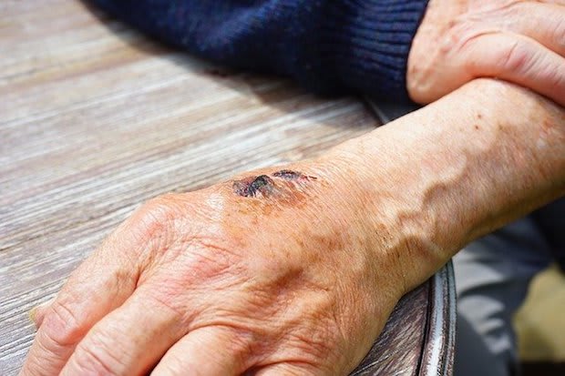 a scab on a person’s hand