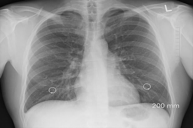 an x ray of human lungs