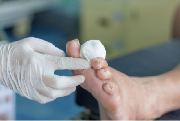 Wound care on a diabetic foot