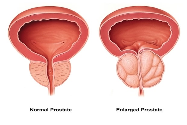 a diagram of a normal prostate vs. an enlarged prostate