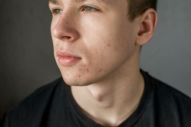 a man with facial acne