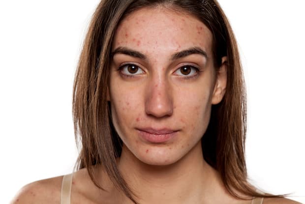 a woman with facial acne