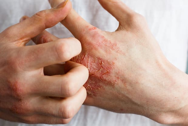 a person itching eczema on their hand