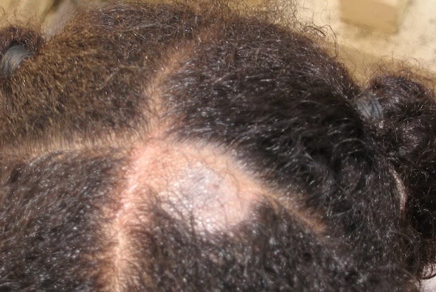 image of scalp with tinea capitis