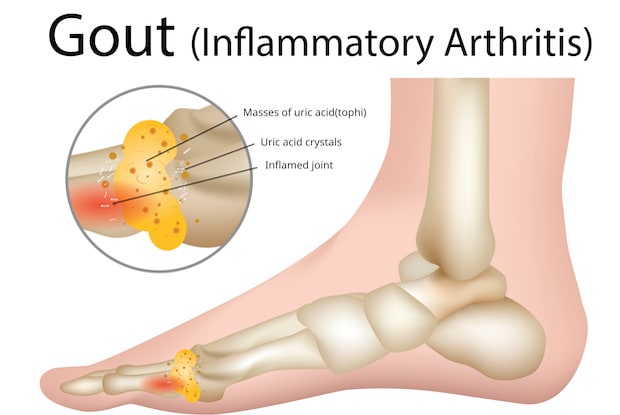 a diagram showing gout in the big toe