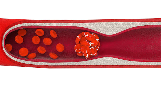 an animation of a blood clot in a vessel