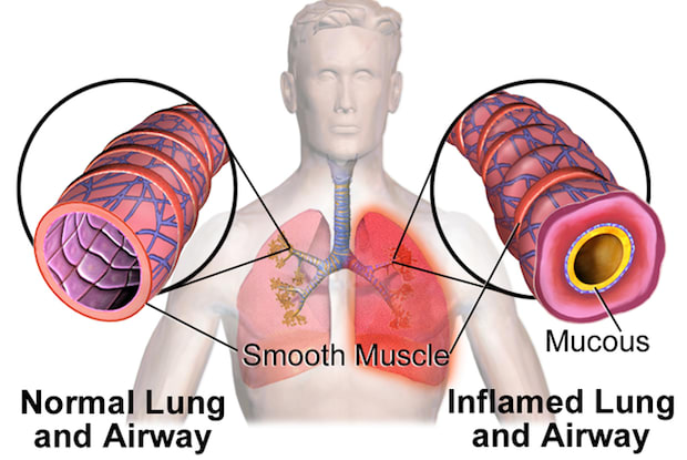 a diagram comparing a normal airway to an airway affected by asthma