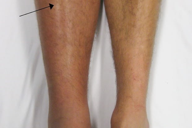 comparison between swollen leg and normal leg