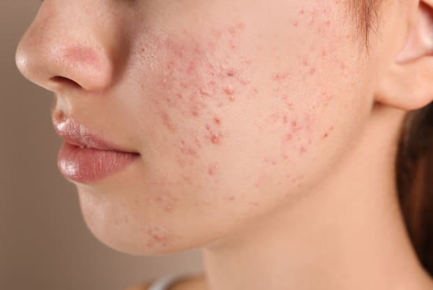 a woman with acne on her face