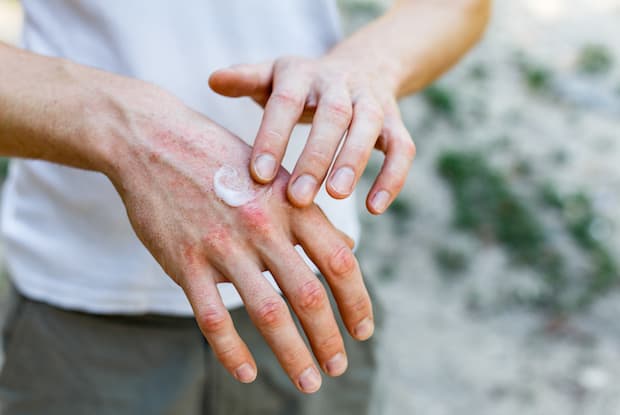 a man putting cream on his hand