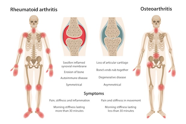 two skeletons affected by arthritis