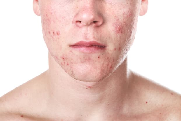 a man with acne