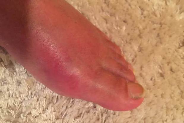 a swollen foot inflamed with gout