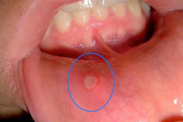 a canker-like sore in a person’s inner lip