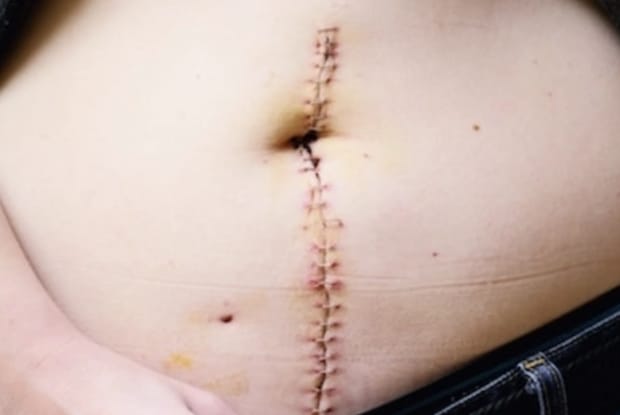 a stomach with stitches