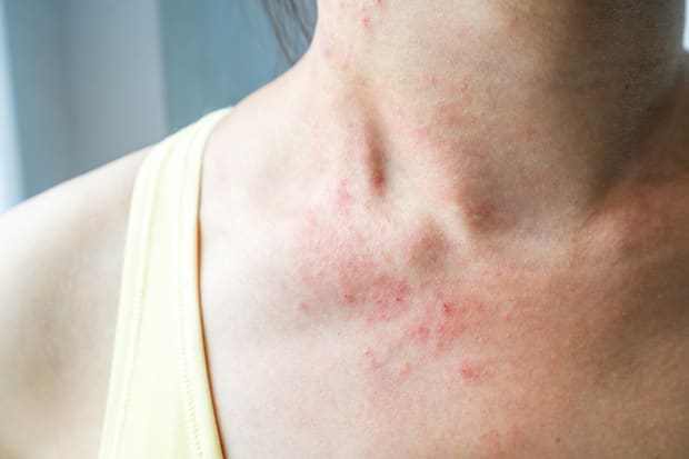 skin rash around the neck