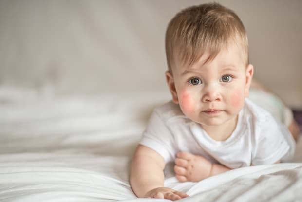 a baby with eczema