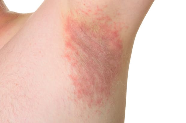 a rash in someone’s armpit