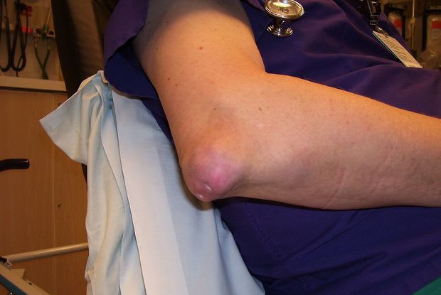 a person with tophaceous gout on their elbow