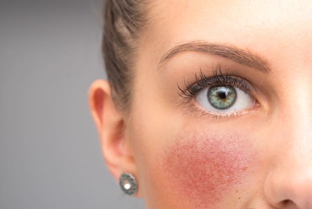 a woman with rosacea with her cheeks