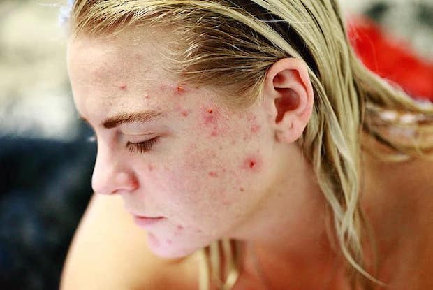 A woman with acne in front of a light blue background