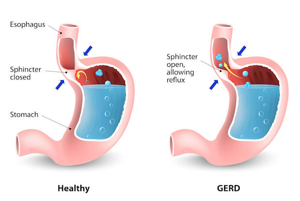 a diagram showing how GERD occurs