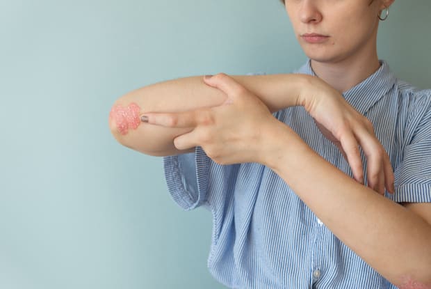 a person with a patch of psoriasis