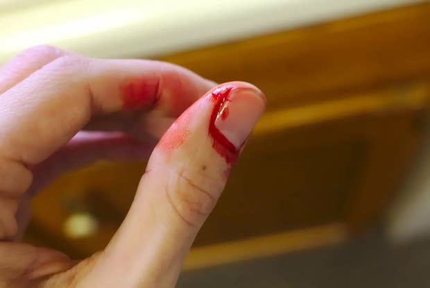 a person with an injured thumb that is bleeding around the nail bed