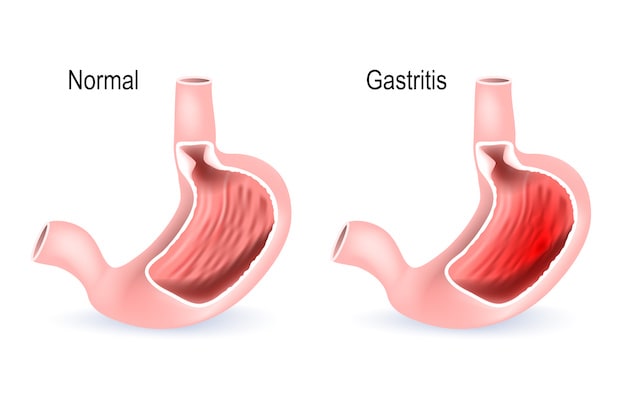 an inflamed stomach