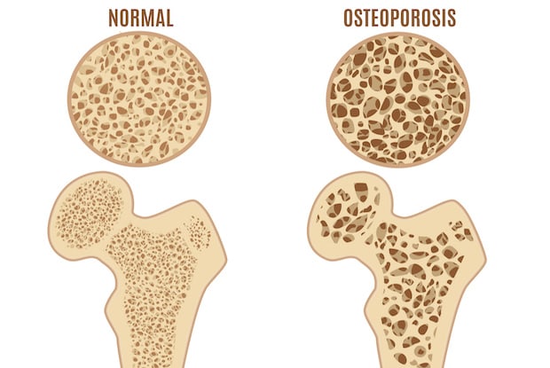 Osteoporosis Symptoms and Treatments: The Silent Disease