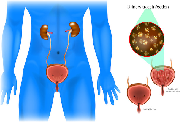 a diagram of how a urinary tract infection affects the bladder