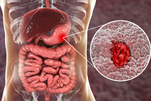 a diagram of a stomach ulcer