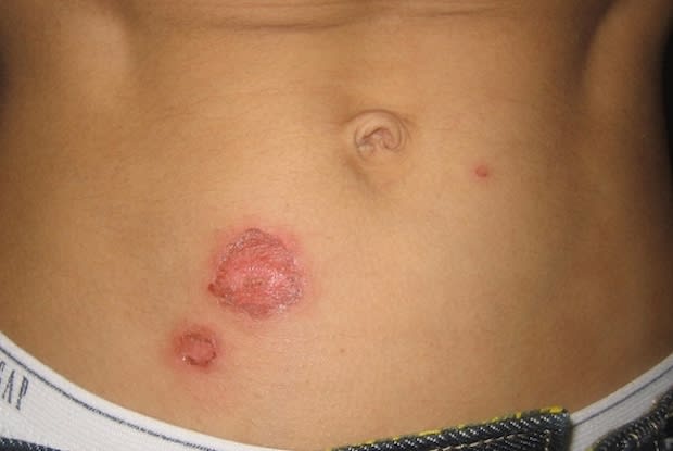 Impetigo on the stomach of a male