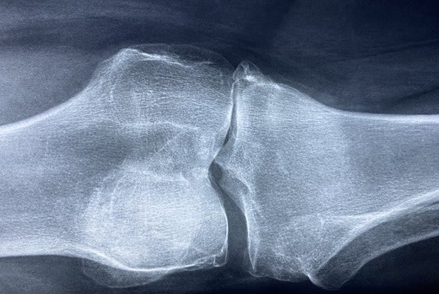 an x-ray of a joint affected by arthritis