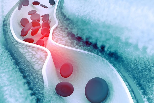 an illustration of a clogged blood vessel