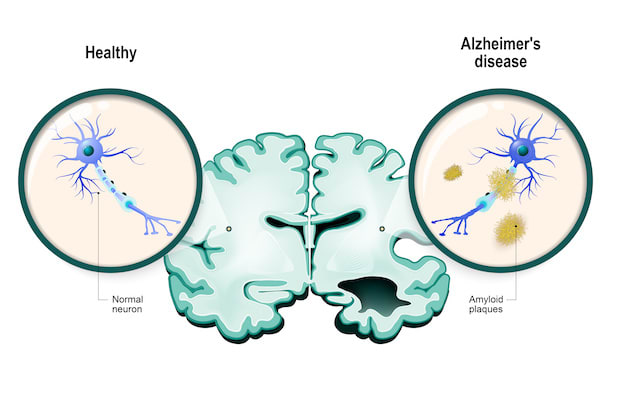 a diagram of Alzheimer