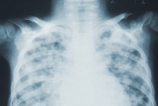 an x-ray of the lung area