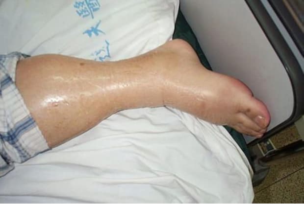 a leg swollen with edema