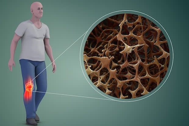 an illustration of what osteoporosis looks like