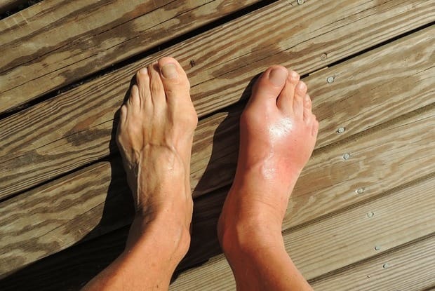 a pair of feet with one foot red and swollen with gout