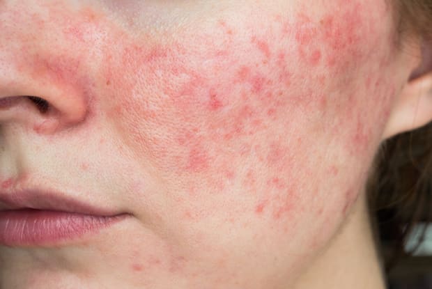 a face with rosacea