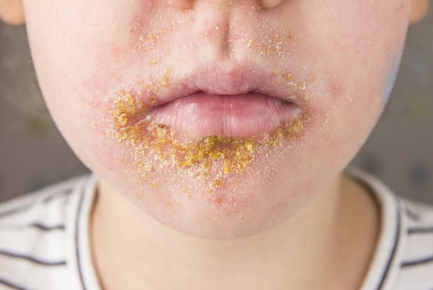 a child with yellow sores on their mouth