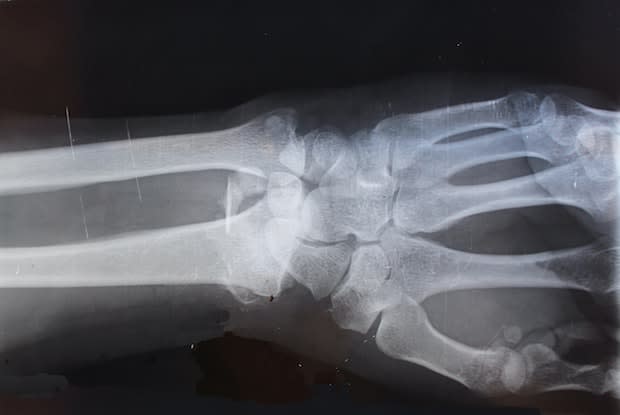 an x ray of a wrist